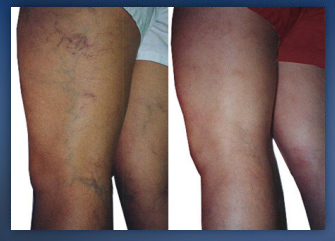 Why Choose Laser Treatment for Varicose Veins