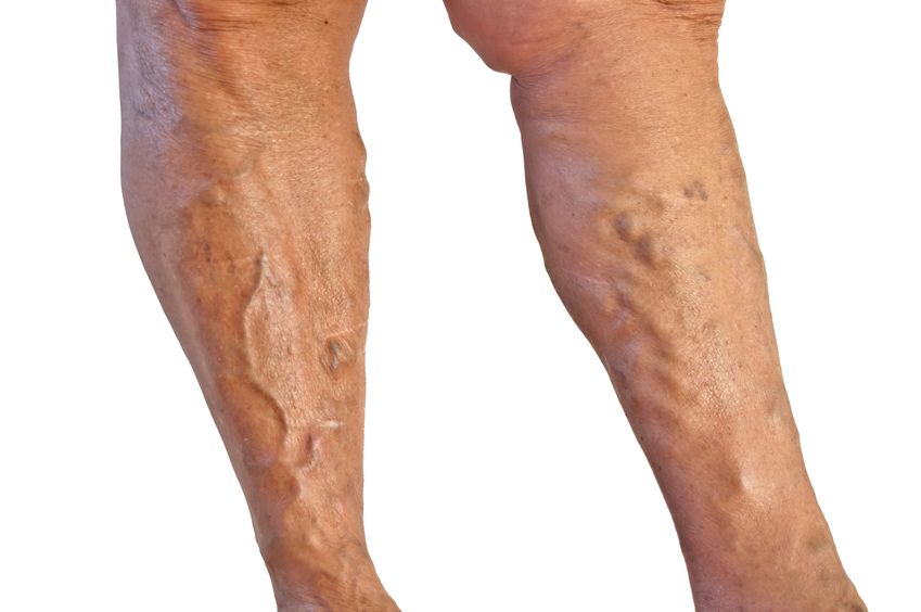 Getting The Best Illinois Breakthrough Technology for Treating Spider Veins