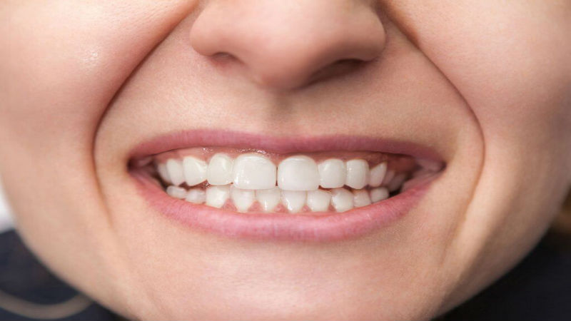 Who Can Benefit from Dental Crowns?