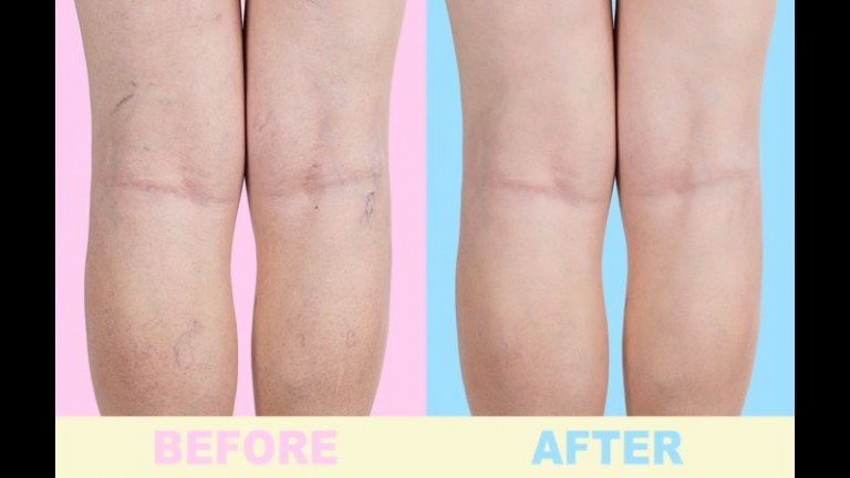 Benefits of Varicose Vein Treatment in Bensalem, PA