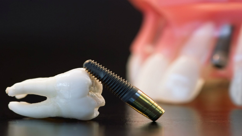 Great Dental Work—Dental Implants in Leesburg