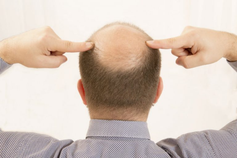 What You Should Know When Considering Hair Restoration in NYC