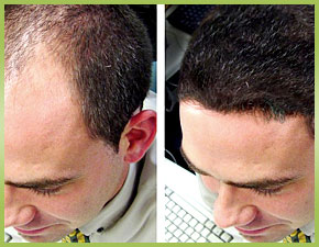 4 Advantages Of Having Hair Transplantation In Fort Lauderdale, FL