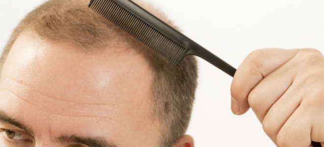 Things to Know When Considering FUE Hair Transplant in Pennsylvania